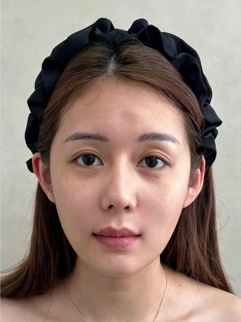 现代美眼趋势：双眼皮手术的新潮流